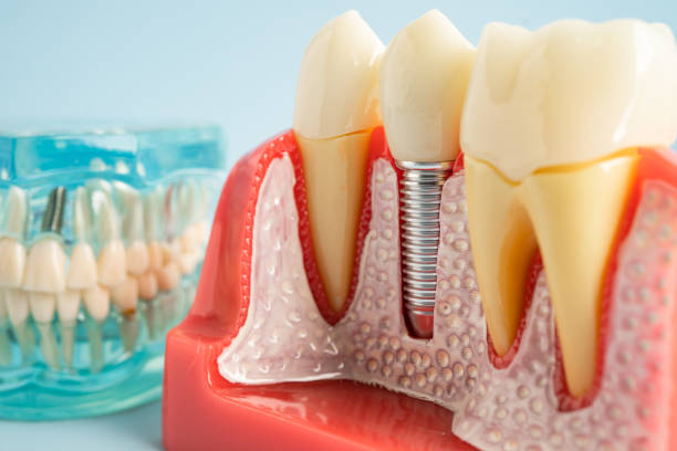 Best Tooth Extraction  in Orangetree, FL